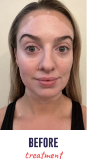 A face of a young woman with vitiligo, showing depigmentation before treatment with OPZELURA.