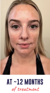 A face of a young woman with vitiligo, showing repigmentation progress at 12 months of treatment.