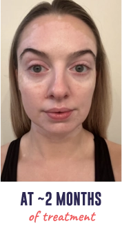 A face of a young woman with vitiligo, showing repigmentation progress at 2 months of treatment.