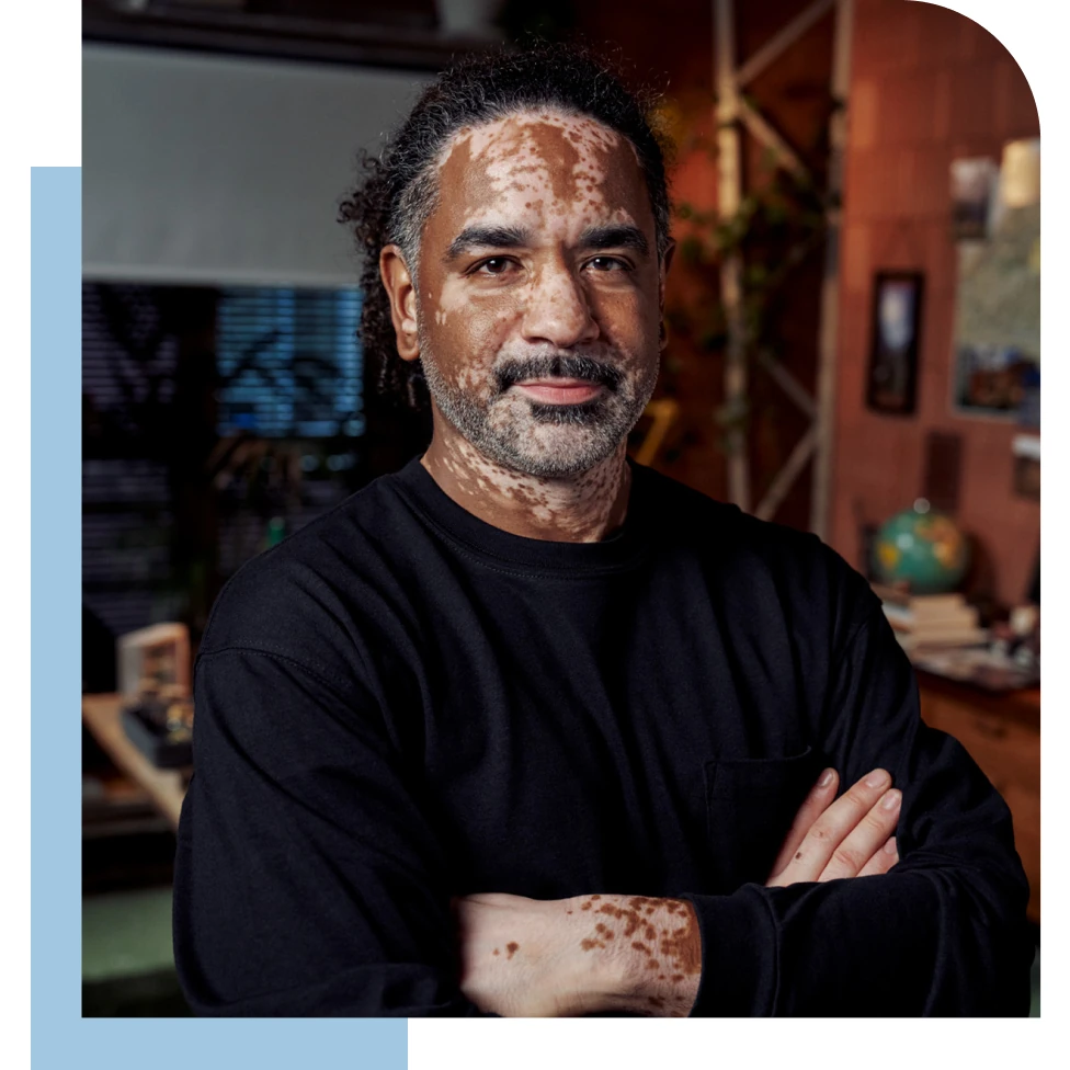 An image of a man with vitiligo facing the camera confidently crossing his arms. 
