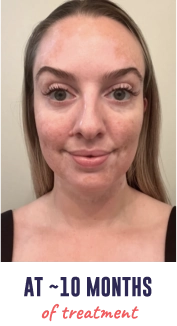 A face of a young woman with vitiligo, showing repigmentation progress at 10 months of treatment.