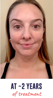 A face of a young woman with vitiligo, showing repigmentation progress at 2 years of treatment.