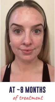 A face of a young woman with vitiligo, showing repigmentation progress at 8 months of treatment.